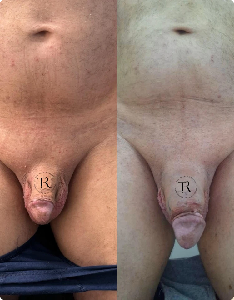 botox-3